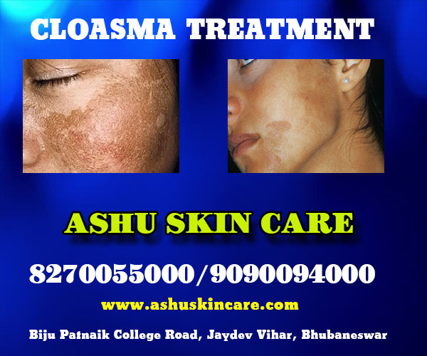 best chloasma treatment clinic  in bhubaneswar near aiims hospital